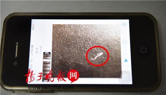 宜兴男子眼中拽出一条18mm长白线虫