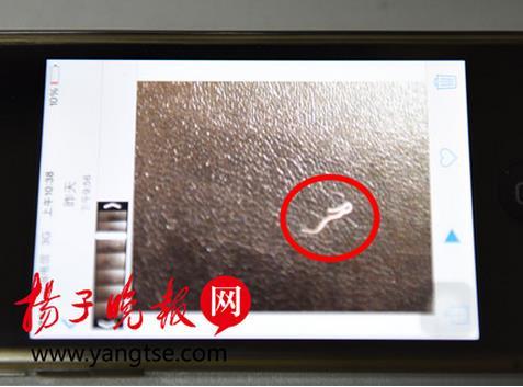 宜兴一男子眼中拽出18mm长寄生虫(图)